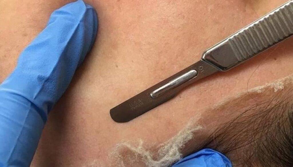 مميزات الديرمابلانينج Dermaplaning